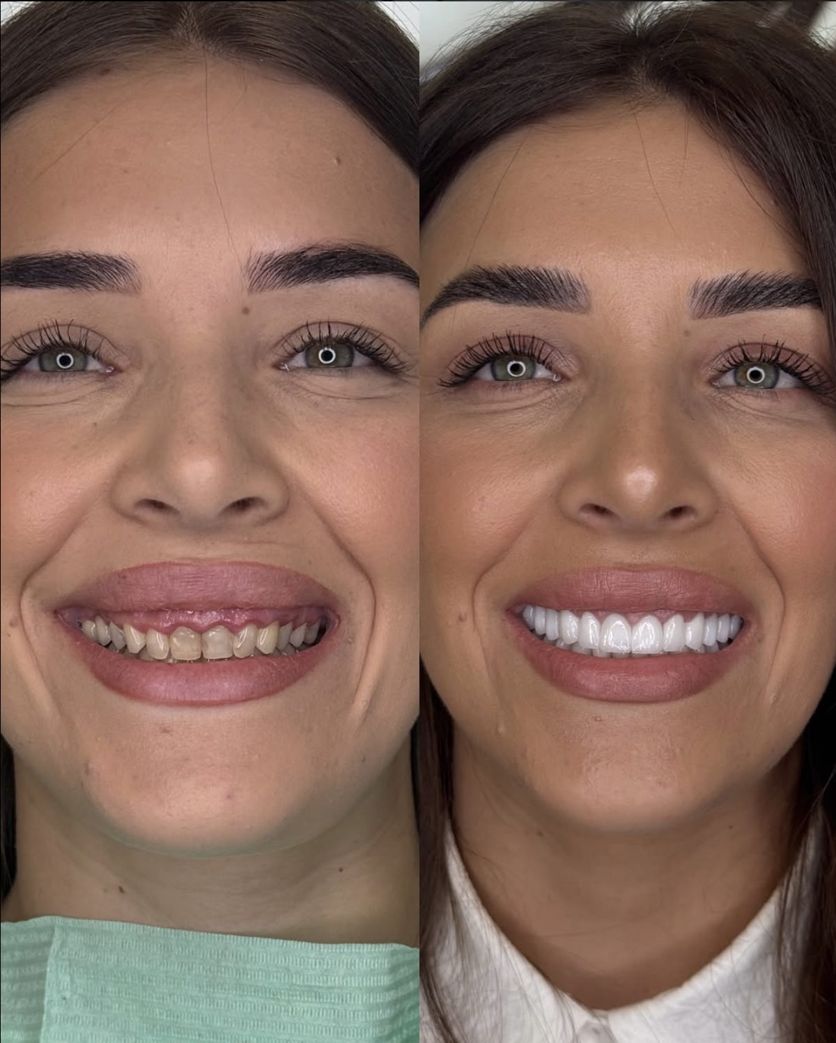 Hollywood smile