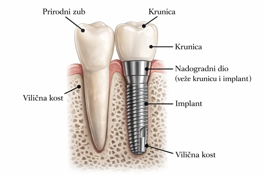 dentalni implant